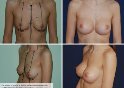 Aumento-pecho.2-1200x900