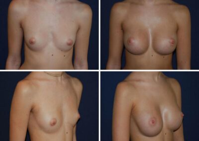 Aumento-pecho.3-1200x900