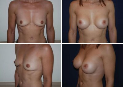 Aumento-pecho.5-1200x900