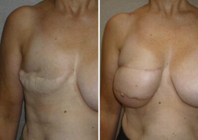 Reconstruccion-pecho.2-1200x900